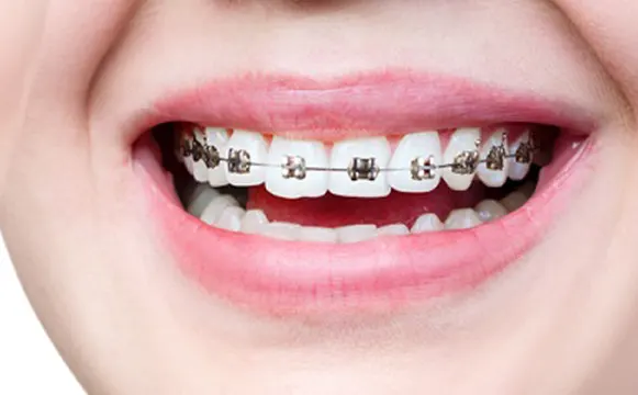 braces-before-3