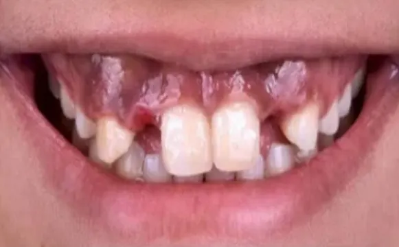 crown-before