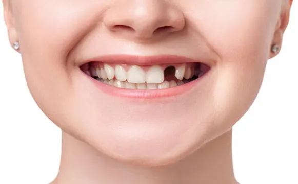 dental-implant-before