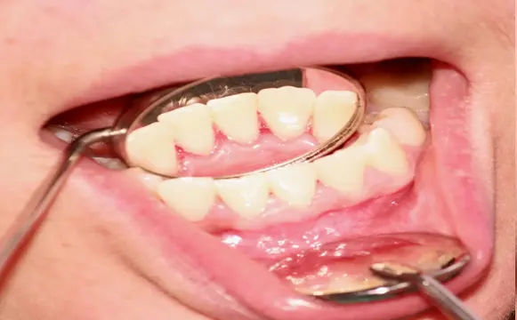 teeth-polishing-after