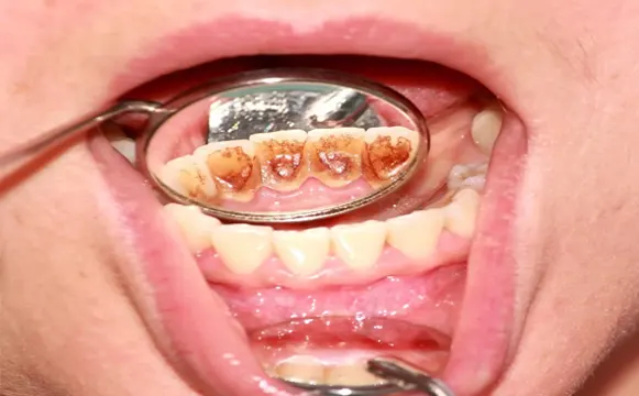 teeth-polishing-before