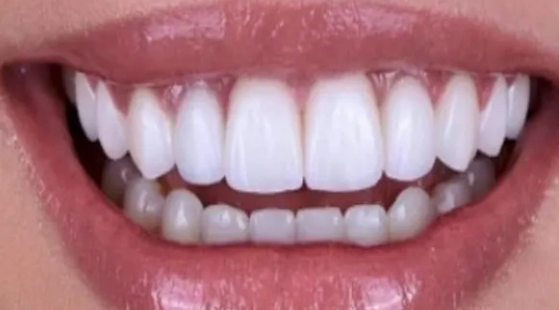 after-crown -50kb (1)