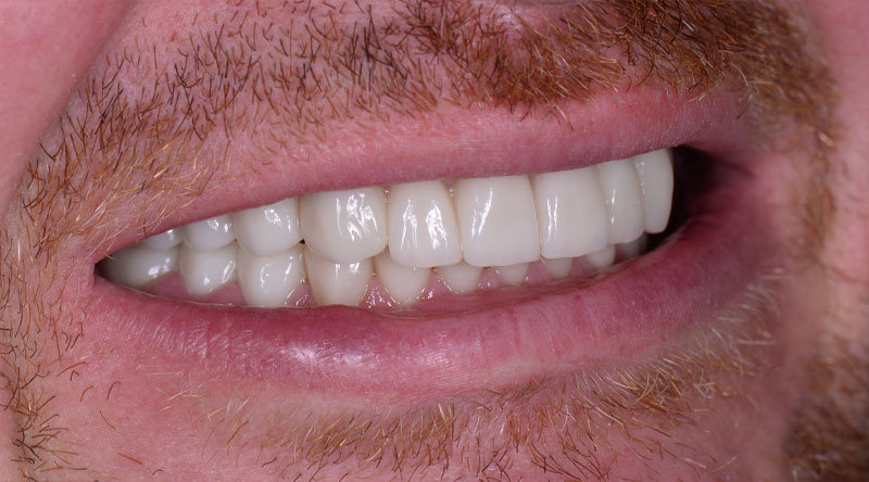 full-mouth-dental-implant-after-2