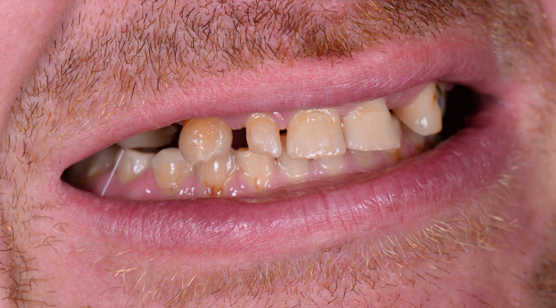 full-mouth-dental-implant-before-2 full-mouth-dental-implant-before-2