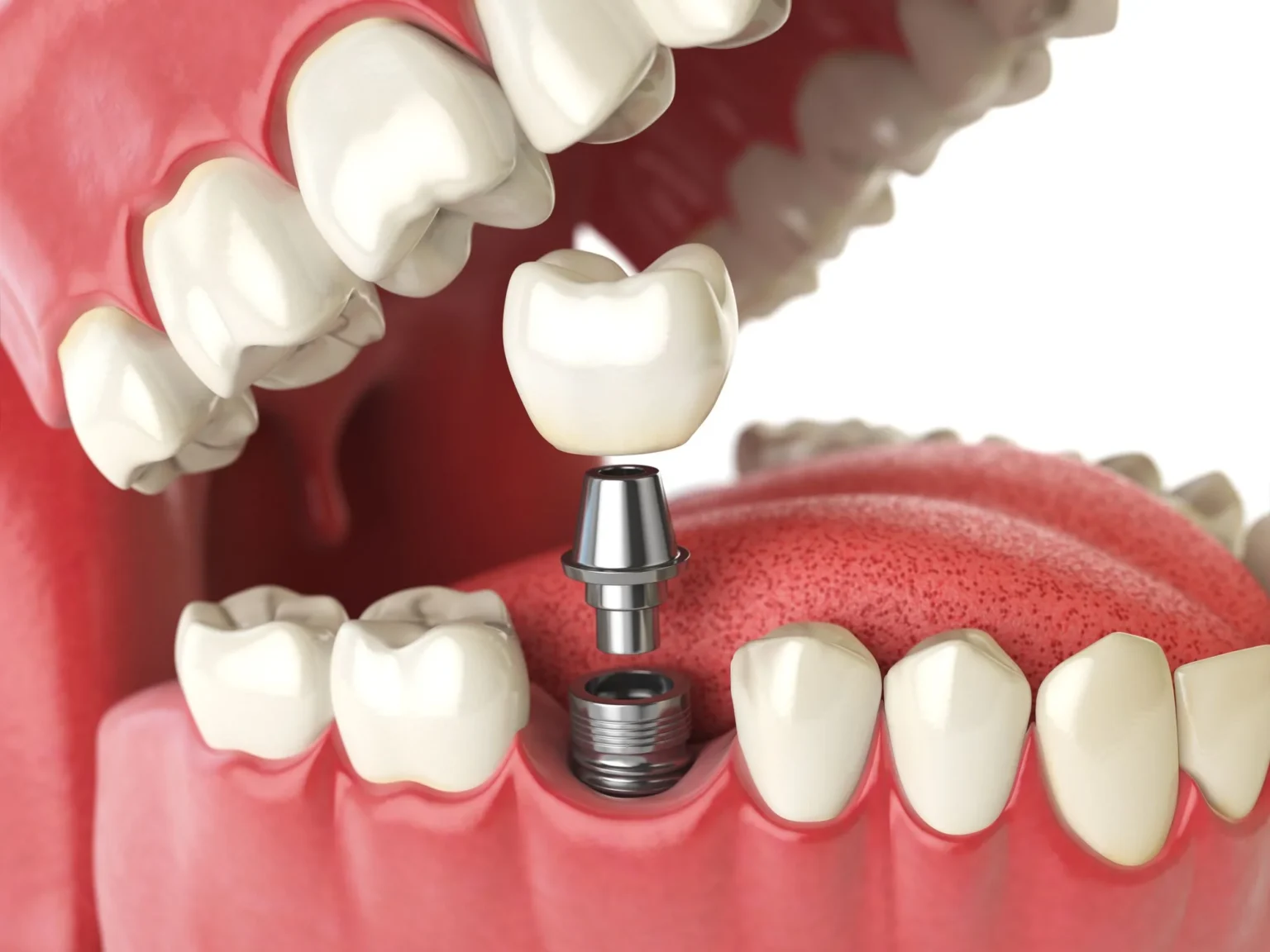 Dental Implants Tax